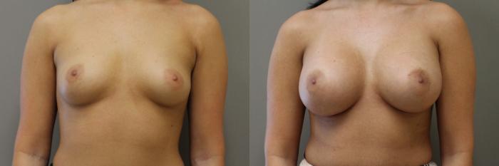 Breast Augmentation Case 164 Before & After View #1 | Webster, TX | Houston Plastic and Reconstructive Surgery