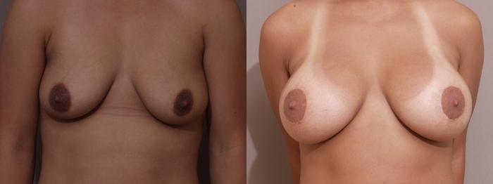 Breast Augmentation Case 18 Before & After View #1 | Webster, TX | Houston Plastic and Reconstructive Surgery