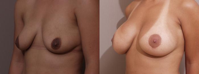 Breast Augmentation Case 18 Before & After View #2 | Webster, TX | Houston Plastic and Reconstructive Surgery