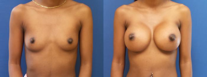 Breast Augmentation Case 186 Before & After View #1 | Webster, TX | Houston Plastic and Reconstructive Surgery