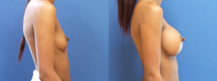 Breast Augmentation Case 186 Before & After View #2 | Webster, TX | Houston Plastic and Reconstructive Surgery