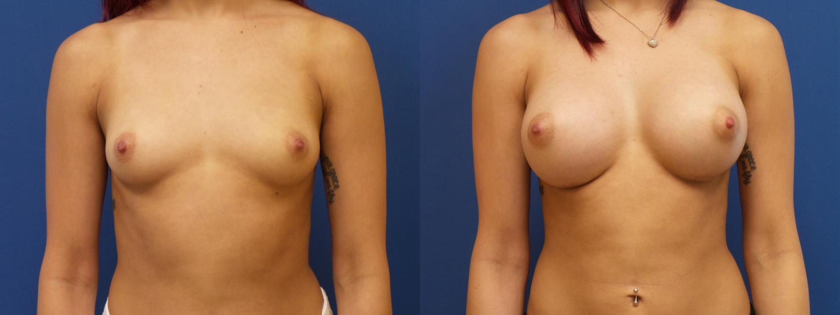 Breast Augmentation Case 192 Before & After View #1 | Webster, TX | Houston Plastic and Reconstructive Surgery