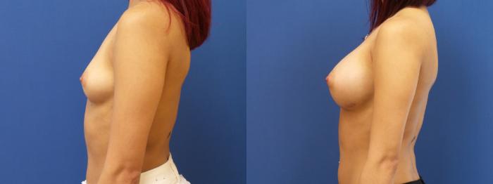 Breast Augmentation Case 192 Before & After View #2 | Webster, TX | Houston Plastic and Reconstructive Surgery