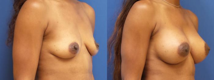 Breast Augmentation Case 195 Before & After View #3 | Webster, TX | Houston Plastic and Reconstructive Surgery