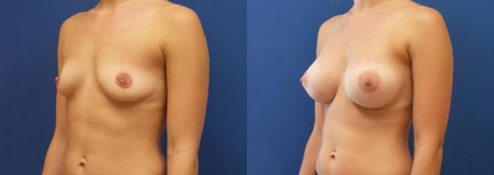 Breast Augmentation Case 205 Before & After View #2 | Webster, TX | Houston Plastic and Reconstructive Surgery