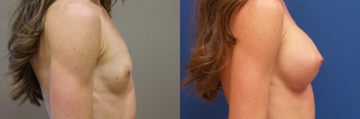 Breast Augmentation Case 207 Before & After View #1 | Webster, TX | Houston Plastic and Reconstructive Surgery