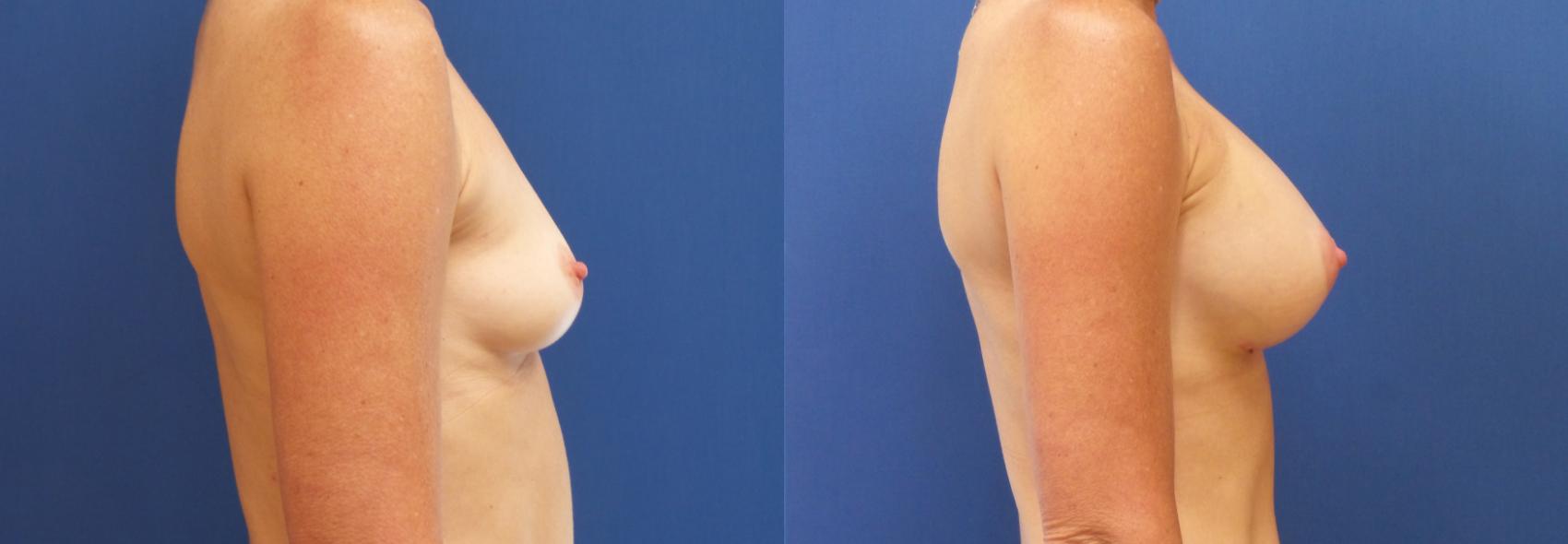 Breast Augmentation Case 208 Before & After View #1 | Webster, TX | Houston Plastic and Reconstructive Surgery