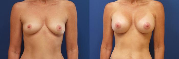 Breast Augmentation Case 208 Before & After View #2 | Webster, TX | Houston Plastic and Reconstructive Surgery