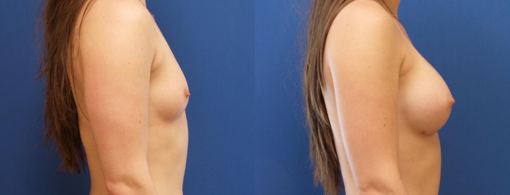 Breast Augmentation Case 210 Before & After View #1 | Webster, TX | Houston Plastic and Reconstructive Surgery