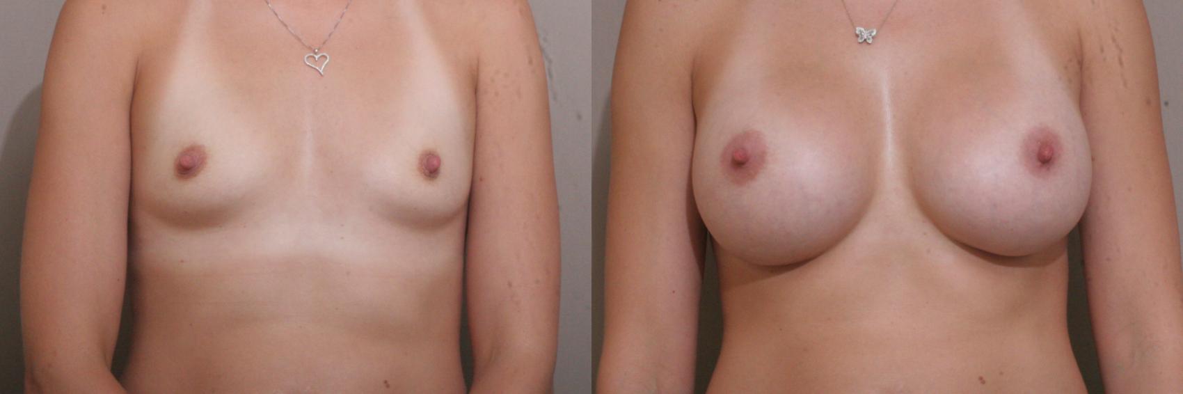 Breast Augmentation Case 24 Before & After View #1 | Webster, TX | Houston Plastic and Reconstructive Surgery