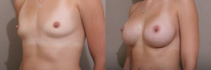 Breast Augmentation Case 24 Before & After View #2 | Webster, TX | Houston Plastic and Reconstructive Surgery