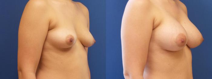 Breast Augmentation Case 255 Before & After View #1 | Webster, TX | Houston Plastic and Reconstructive Surgery
