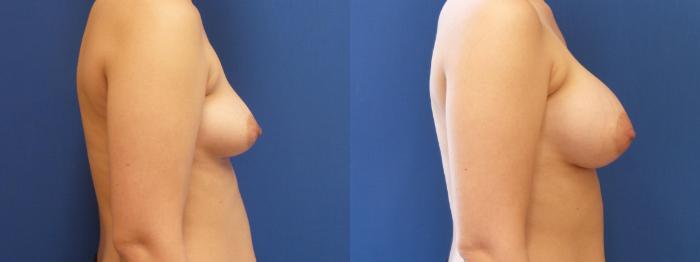 Breast Augmentation Case 255 Before & After View #2 | Webster, TX | Houston Plastic and Reconstructive Surgery