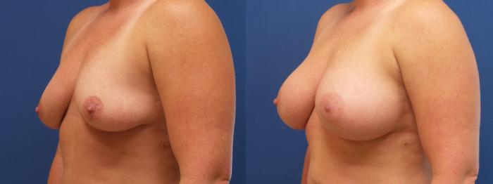 Breast Augmentation Case 257 Before & After View #1 | Webster, TX | Houston Plastic and Reconstructive Surgery