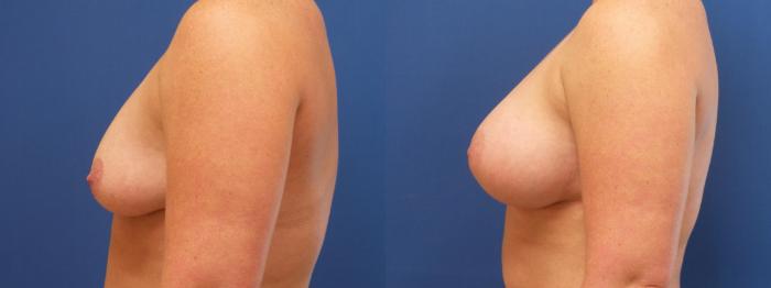 Breast Augmentation Case 257 Before & After View #2 | Webster, TX | Houston Plastic and Reconstructive Surgery