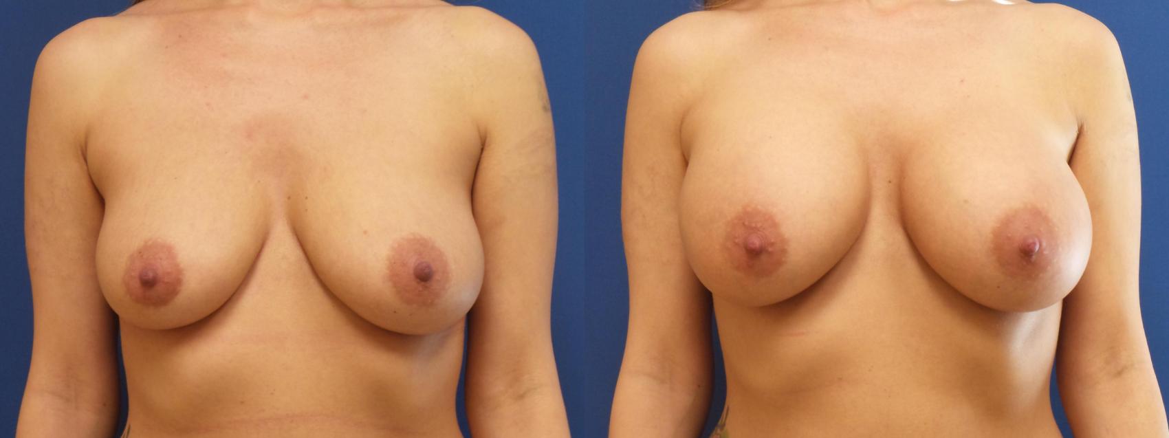 Breast Augmentation Case 269 Before & After View #1 | Webster, TX | Houston Plastic and Reconstructive Surgery