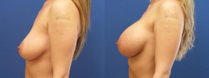 Breast Augmentation Case 269 Before & After View #2 | Webster, TX | Houston Plastic and Reconstructive Surgery