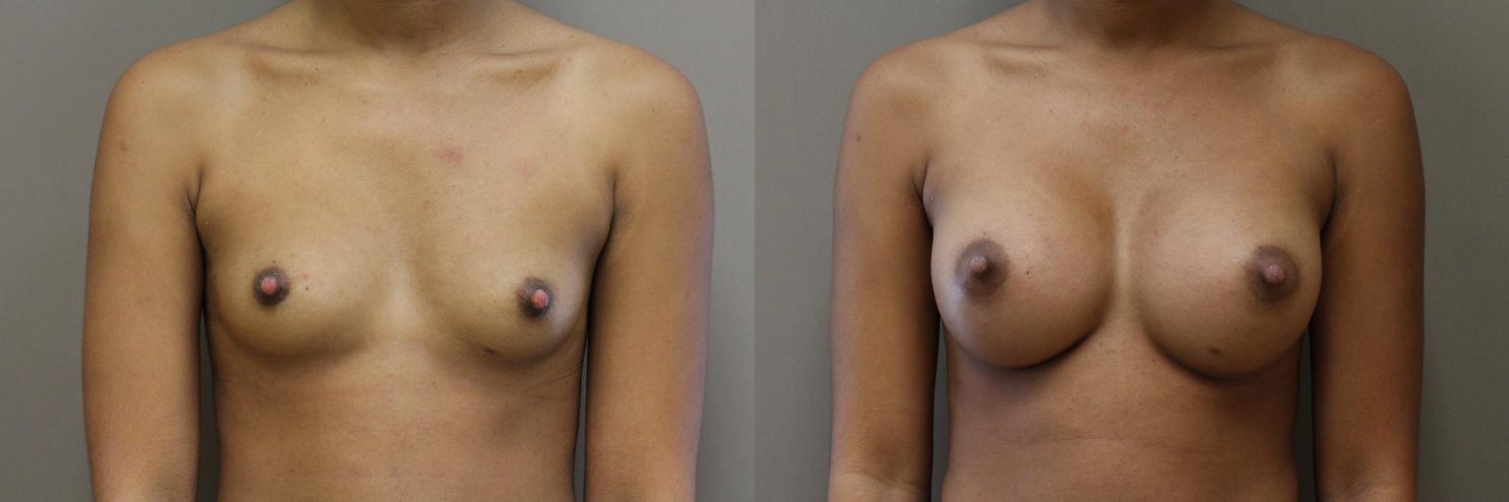 Breast Augmentation Case 285 Before & After Front | Webster, TX | Houston Plastic and Reconstructive Surgery