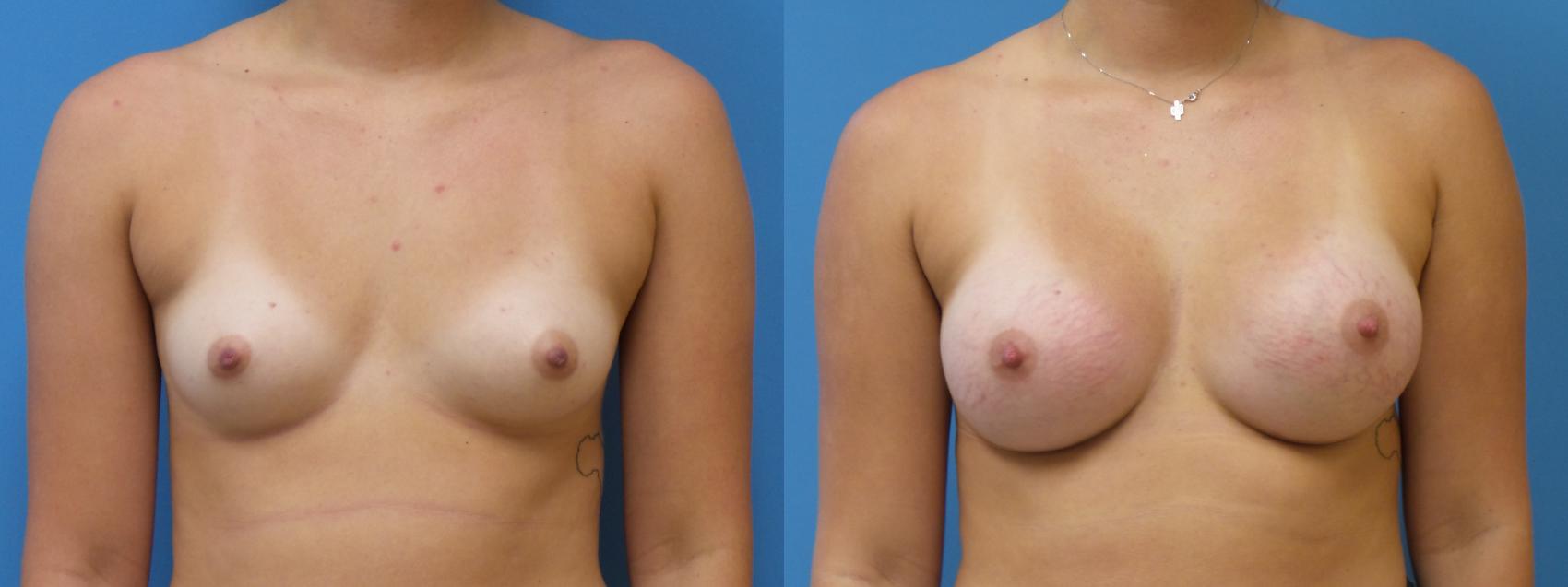 Breast Augmentation Case 289 Before & After Front | Webster, TX | Houston Plastic and Reconstructive Surgery