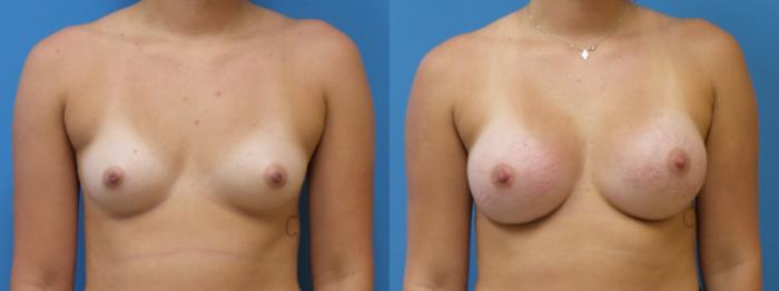 Breast Augmentation Case 289 Before & After Front | Webster, TX | Houston Plastic and Reconstructive Surgery