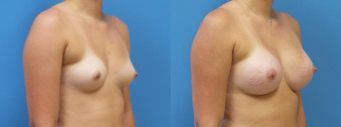 Breast Augmentation Case 289 Before & After Right Oblique | Webster, TX | Houston Plastic and Reconstructive Surgery