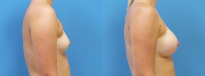 Breast Augmentation Case 289 Before & After Right Side | Webster, TX | Houston Plastic and Reconstructive Surgery