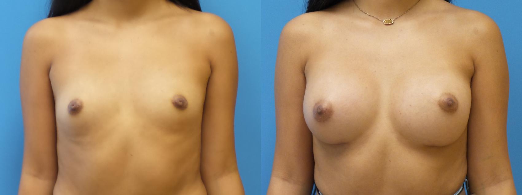 Breast Augmentation Case 291 Before & After Front | Webster, TX | Houston Plastic and Reconstructive Surgery
