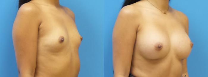 Breast Augmentation Case 291 Before & After Right Oblique | Webster, TX | Houston Plastic and Reconstructive Surgery
