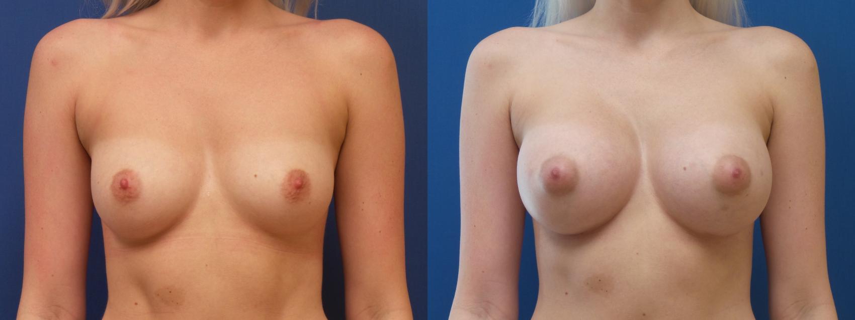 Breast Augmentation Case 293 Before & After Front | Webster, TX | Houston Plastic and Reconstructive Surgery
