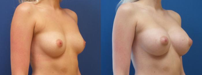 Breast Augmentation Case 293 Before & After Right Oblique | Webster, TX | Houston Plastic and Reconstructive Surgery