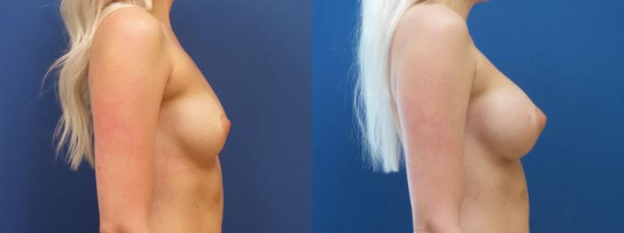 Breast Augmentation Case 293 Before & After Right Side | Webster, TX | Houston Plastic and Reconstructive Surgery