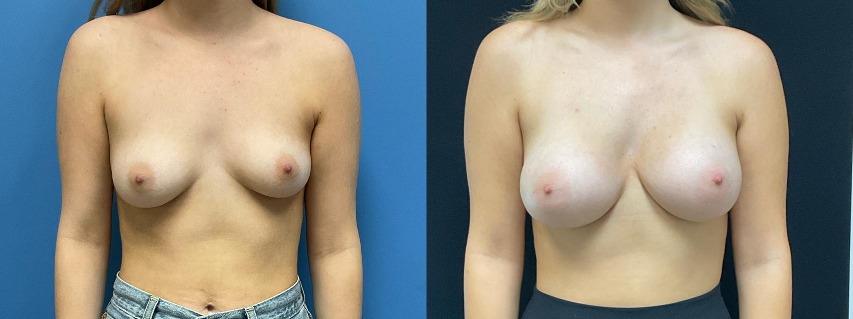 Breast Augmentation Case 307 Before & After Front | Webster, TX | Houston Plastic and Reconstructive Surgery