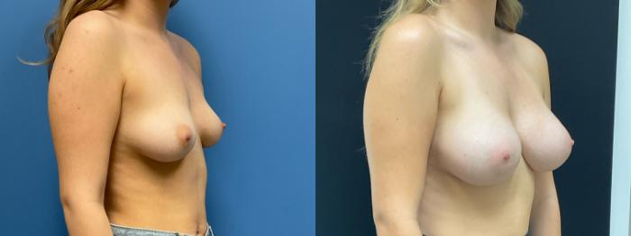 Breast Augmentation Case 307 Before & After Right Oblique | Webster, TX | Houston Plastic and Reconstructive Surgery