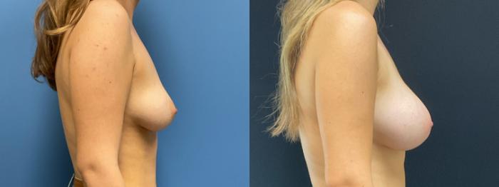 Breast Augmentation Case 307 Before & After Right Side | Webster, TX | Houston Plastic and Reconstructive Surgery