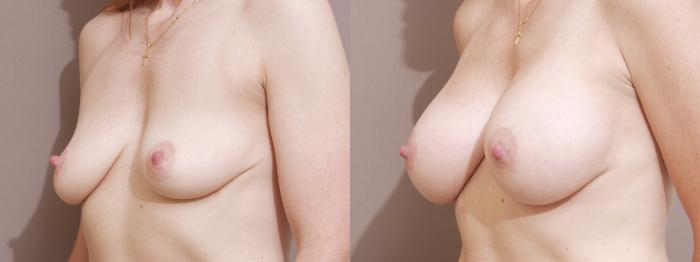 Breast Augmentation Case 33 Before & After View #2 | Webster, TX | Houston Plastic and Reconstructive Surgery