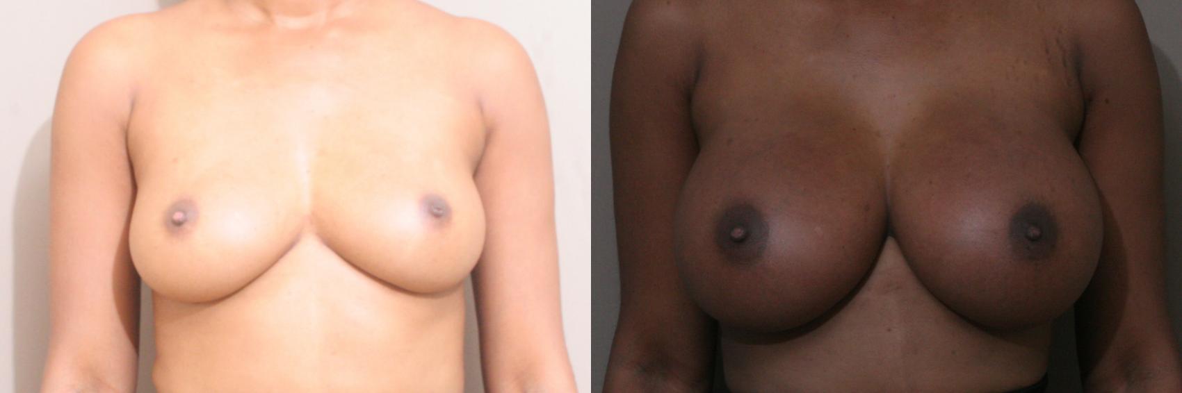 Breast Augmentation Case 39 Before & After View #1 | Webster, TX | Houston Plastic and Reconstructive Surgery