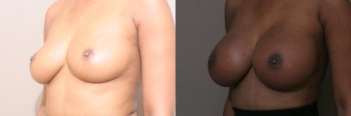 Breast Augmentation Case 39 Before & After View #2 | Webster, TX | Houston Plastic and Reconstructive Surgery