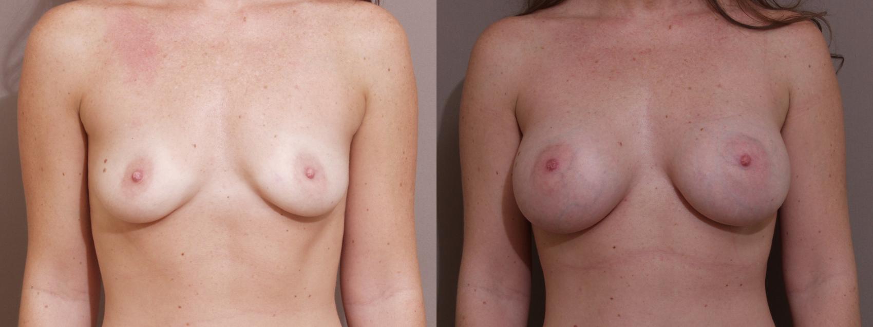 Breast Augmentation Case 40 Before & After View #1 | Webster, TX | Houston Plastic and Reconstructive Surgery