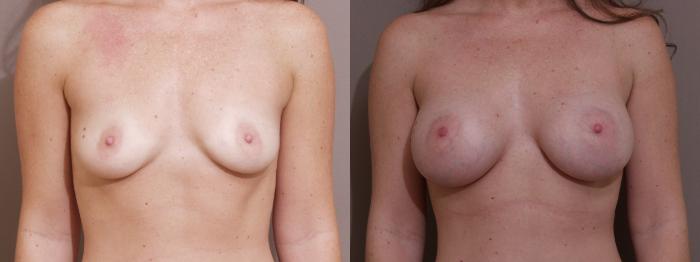 Breast Augmentation Case 40 Before & After View #1 | Webster, TX | Houston Plastic and Reconstructive Surgery