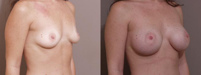 Breast Augmentation Case 40 Before & After View #2 | Webster, TX | Houston Plastic and Reconstructive Surgery