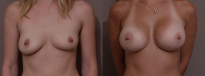 Breast Augmentation Case 49 Before & After View #1 | Webster, TX | Houston Plastic and Reconstructive Surgery