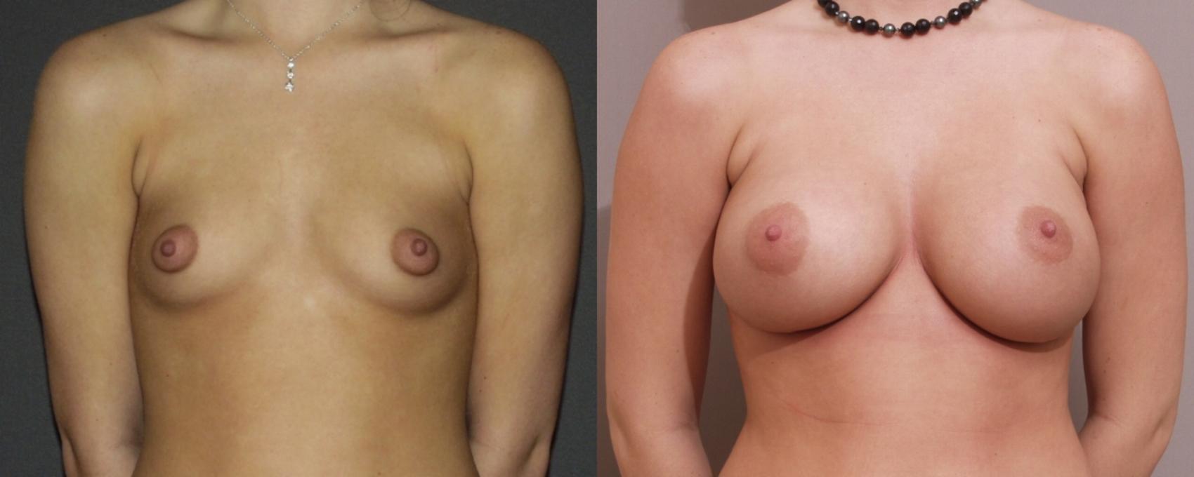 Breast Augmentation Case 50 Before & After View #1 | Webster, TX | Houston Plastic and Reconstructive Surgery