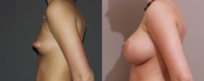Breast Augmentation Case 50 Before & After View #2 | Webster, TX | Houston Plastic and Reconstructive Surgery