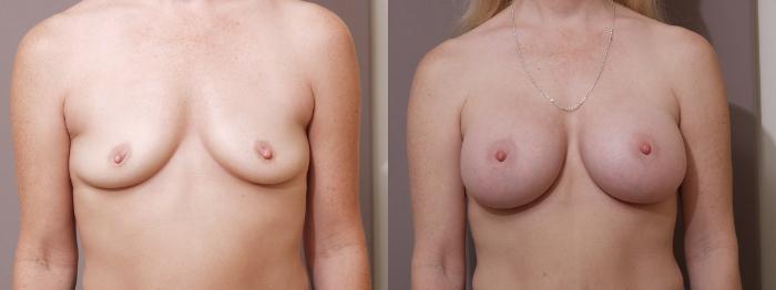 Breast Augmentation Case 59 Before & After View #1 | Webster, TX | Houston Plastic and Reconstructive Surgery