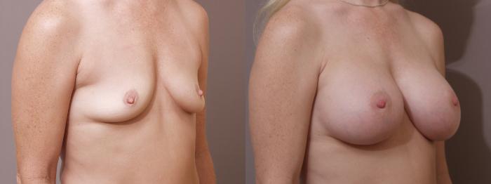 Breast Augmentation Case 59 Before & After View #2 | Webster, TX | Houston Plastic and Reconstructive Surgery
