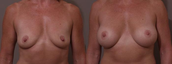 Breast Augmentation Case 60 Before & After View #1 | Webster, TX | Houston Plastic and Reconstructive Surgery