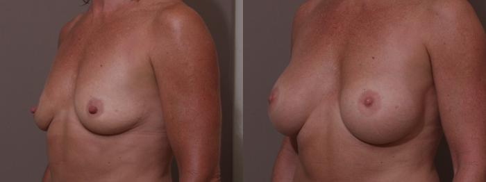 Breast Augmentation Case 60 Before & After View #2 | Webster, TX | Houston Plastic and Reconstructive Surgery