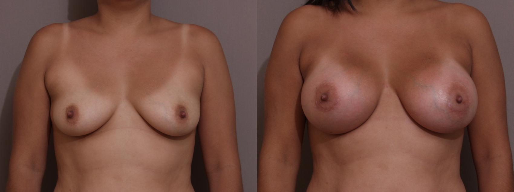 Breast Augmentation Case 64 Before & After View #1 | Webster, TX | Houston Plastic and Reconstructive Surgery