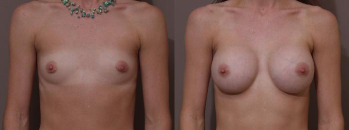 Breast Augmentation Case 65 Before & After View #1 | Webster, TX | Houston Plastic and Reconstructive Surgery