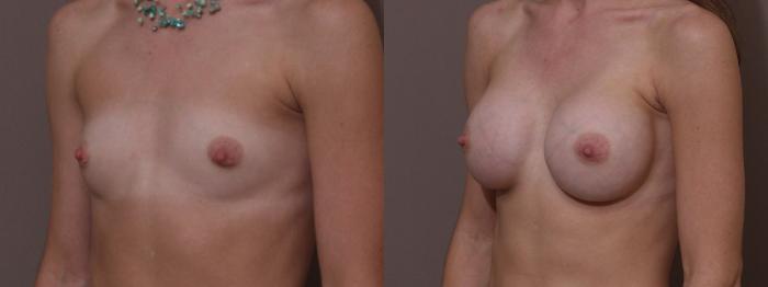 Breast Augmentation Case 65 Before & After View #2 | Webster, TX | Houston Plastic and Reconstructive Surgery